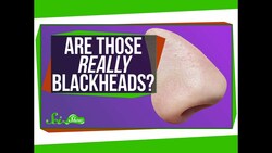 Are Those Really Blackheads? Instructional Video