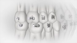How Braces Straighten Your Teeth Instructional Video
