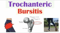 Trochanteric Bursitis (Greater Trochanteric Pain Syndrome) | Causes, Symptoms, Diagnosis, Treatment Instructional Video