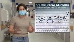 Tuberculosis cases are spiking in Montreal — but the general public shouldn’t worry News Clip