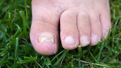 Fungal infection on the nails of the feet. Stock Footage