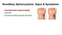 Hereditary Spherocytosis | Pathophysiology, Symptoms, Diagnosis and Treatment Instructional Video