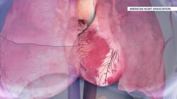 New tech is making diagnosing, treating heart defects easier News Clip