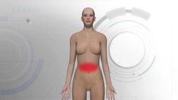 A rare sexually transmitted disease may turn into a "superbug" Instructional Video