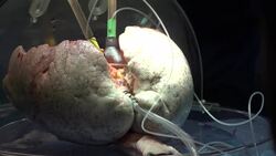 Costs around lung transplant draining savings: N.S. recipient News Clip