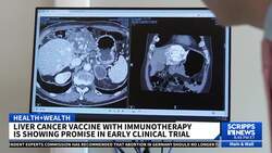 Vaccine being developed to fight tumors in liver cancer patients News Clip