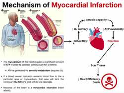 The Mechanism of a Myocardial Infarction (Heart Attack) Instructional Video