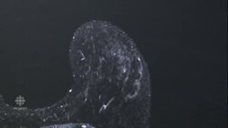 MRIs of dense breasts find more cancer, false positives News Clip