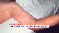What to know about New Jersey’s measles uptick News Clip