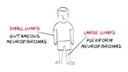 What is Neurofibromatosis Type 1 (NF1)? Instructional Video