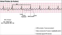 EKG Patterns Atrial Flutter & Atrial Fibrillation Instructional Video
