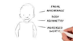 What is Silver-Russell Syndrome (SRS)? Instructional Video