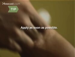 How to Treat a Mosquito Bite Instructional Video