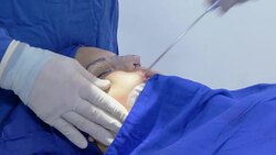 Surgeon doing face liposuction after nasal septum deviation and rhinoplasty surgery on female patient. Female patient under general anesthesia. Stock Footage