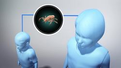 How to avoid and treat head lice Instructional Video