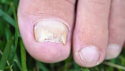 Fungal infection on the nails of the feet. Stock Footage