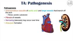 Takayasu’s Arteritis (Pulseless Disease) | Large Vessel Vasculitis |Symptoms, Diagnosis, Treatment Instructional Video
