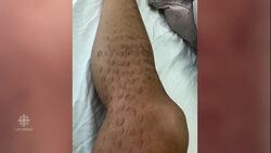 Laser hair removal procedure leaves woman with intense scarring News Clip