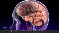 Women at far greater risk of strokes, report warns News Clip