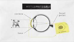 TED-Ed: How does laser eye surgery work? | Dan Reinstein Instructional Video