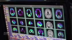 First drug to slow Alzheimer's approved in Canada News Clip