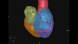 Rotating  view of CTA ( Computed topographic angiography) of Coronary artery Stock Footage
