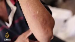 Infectious diseases spread amid unhygienic conditions in Gaza News Clip