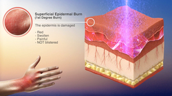 Assessing Burns - The Types and Severity of Burns (First, Second and Third Degree Burns) Instructional Video