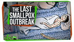 The Last Major Smallpox Outbreak in America Instructional Video