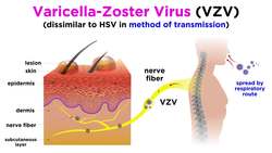 Chickenpox and Shingles (Varicella-Zoster Virus) Instructional Video