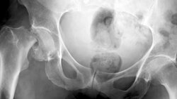 Vitamin D and the Sun Instructional Video