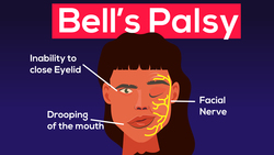 Bells Palsy: Facial Nerve Weakness Instructional Video