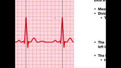 Calculating Heart Rate [HR] from an Electrokardiogram [EKG] (2) Instructional Video