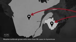 Once declared eradicated, measles is surging in parts of Canada News Clip