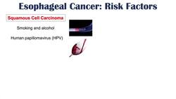 Esophageal Cancer | Risk Factors, Pathogenesis, Signs and Symptoms, Diagnosis, Treatment Instructional Video