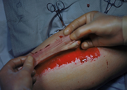 Transfusiones de sangre: Vietnam Instructional Video