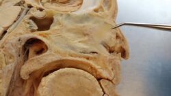 Understanding the Nasal Septum and Septoplasty Instructional Video