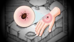 What to know about the bedbug pandemic I Decomplicated Instructional Video