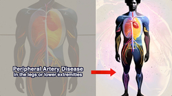 Peripheral Artery Disease (PAD) - The Accumulation of Fatty Plaque in the Arteries Instructional Video