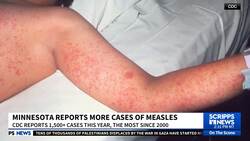 Measles cases climb in Minnesota, part of largest U.S. outbreak since 2000 News Clip