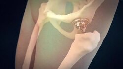 Total Hip Replacement Instructional Video