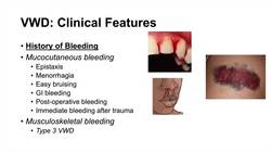 Von Willebrand Disease | Pathophysiology, Types, Symptoms and Treatment Instructional Video