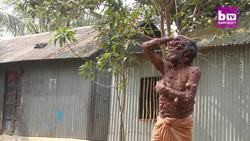 Dad's Entire Body Is Covered In Tumours: BORN DIFFERENT Instructional Video