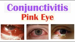 Acute Conjunctivitis (Pink Eye) | Allergic, Bacterial, Viral | Symptoms, Diagnosis, Treatment Instructional Video