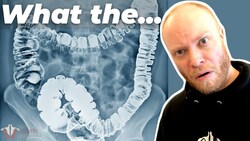 Doctors FOUND Something During My Colonoscopy... Instructional Video