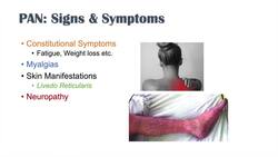 Polyarteritis Nodosa (PAN) | Signs & Symptoms, Diagnosis, Treatment Instructional Video