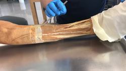 Understanding and Treating Shin Splints Instructional Video