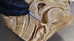 The Anatomy and Importance of the Epiglottis Instructional Video