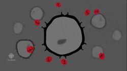 Critical breast cancer medication shortage News Clip