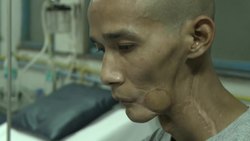 India: Tackling oral cancer in Mumbai Instructional Video